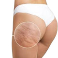 Cellulite and Tightening