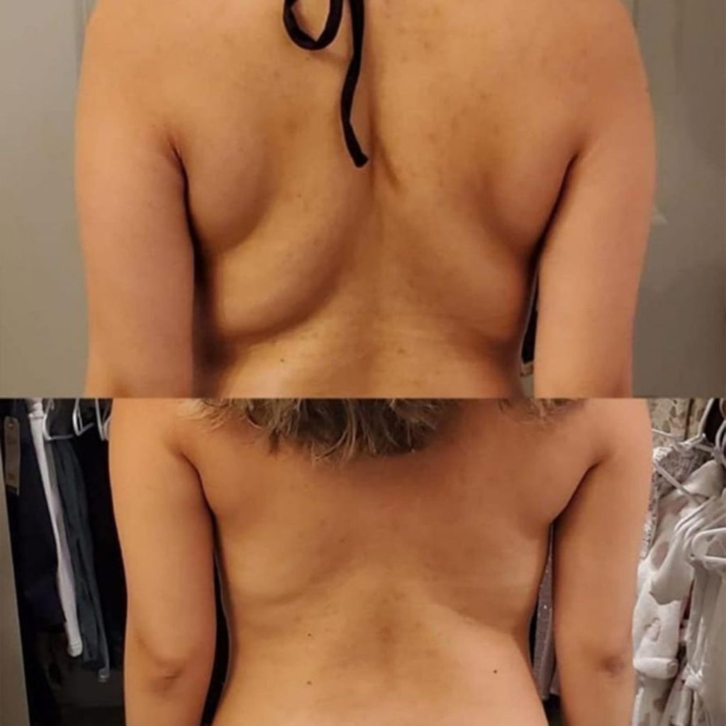 Back and Bra Area