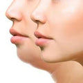 Double Chin and Neck Treatment
